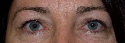 Eyeliner - Behandeling 1 - Na
