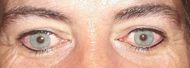 Eyeliner - Behandeling 6 - Na