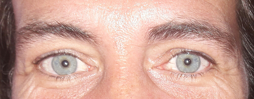 Eyeliner - Behandeling 6 - Voor